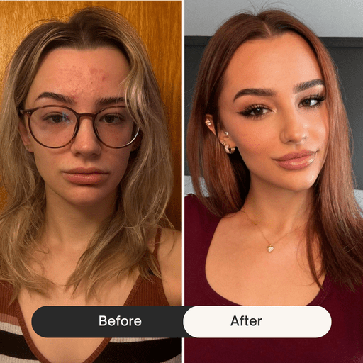 before after